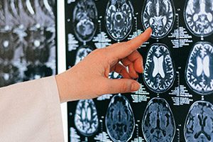 Clark Hudson and Samantha Mills Successfully Defend $9+ Million Dollar Claim Against Neurosurgeon